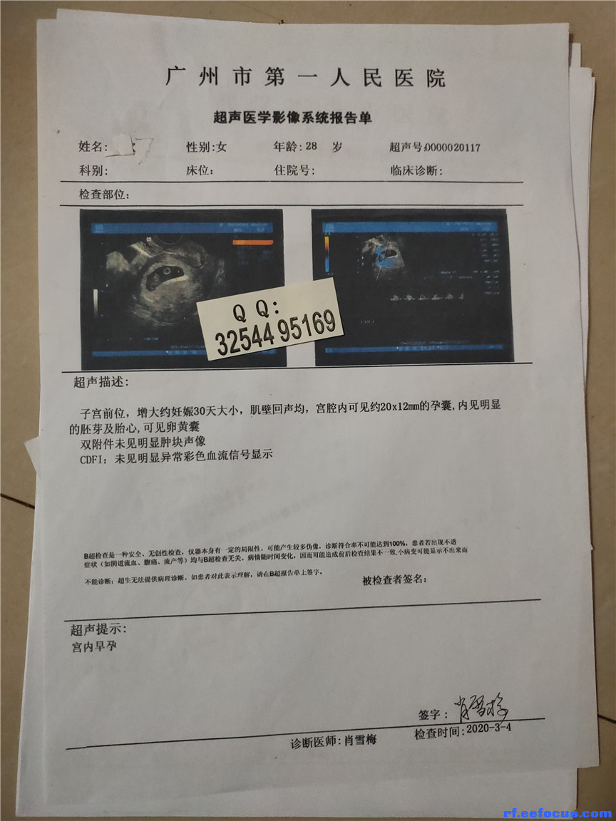 武汉市 贵溪市怀孕一个月b超单 彩色怀孕b超单 检查报告图片